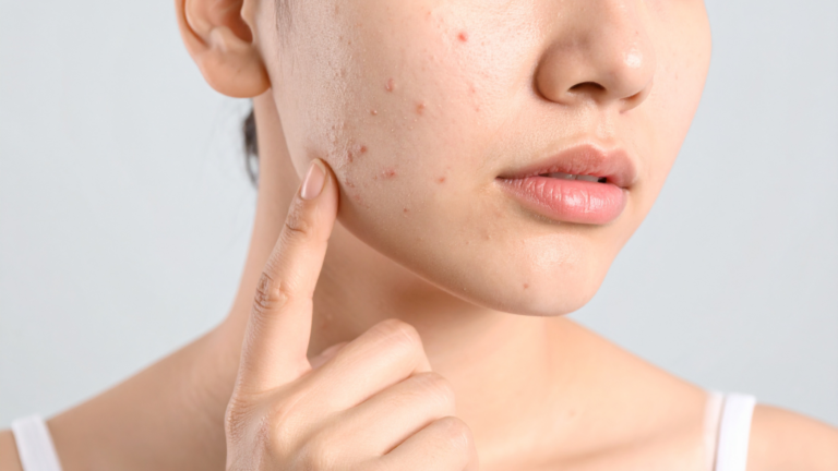 treatments for acne